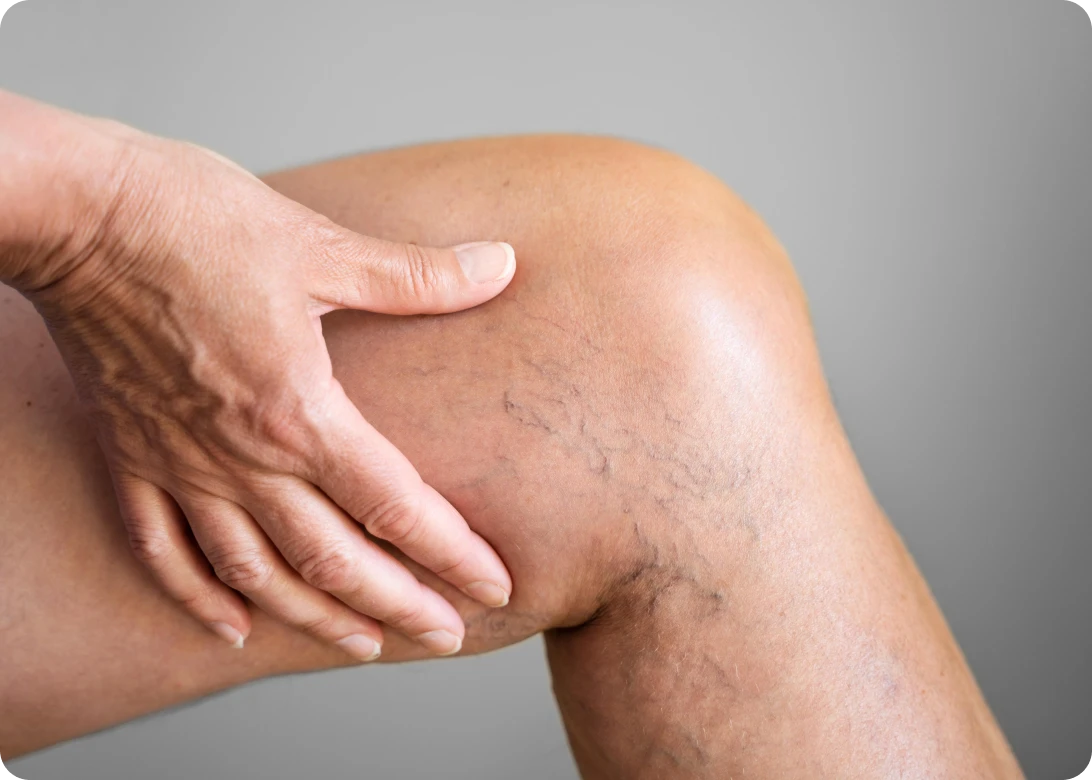 Telangiectasias de Corpo?