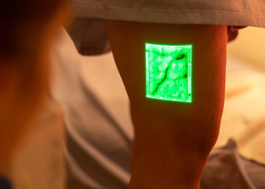 TRATAMENTO DE VARIZES.