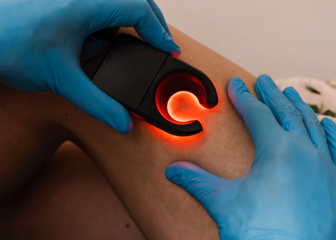 TRATAMENTO DE VARIZES.